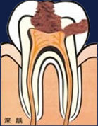 深度龋齿