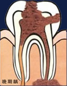 晚期龋齿